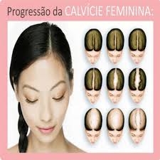 calvicie feminina tem cura casos